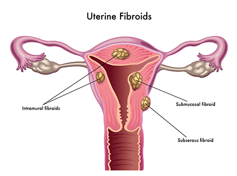What You Should Know About Uterine Fibroids