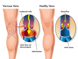 illustration showing varicose veins | Atlanta Vascular & Vein Centers