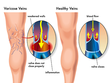 How Dangerous Are Varicose Veins?