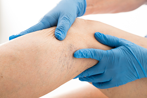 Reasons to Have a Vein Checkup