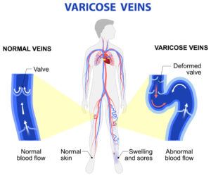 medical diagram showing varicose veins | Atlanta Vascular & Vein Center
