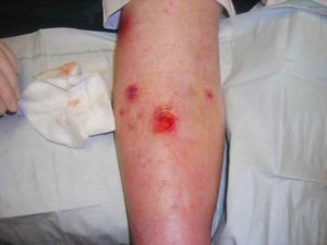 photo of leg ulcer by Jonathan Moore | Wikimiedia Creative Commons