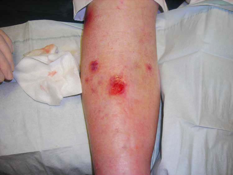 Venous Ulcer Sores How to Treat Atlanta Vascular & Vein Centers