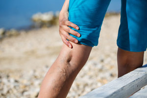 photo of woman touching painful varicose veins on a leg | Dr. Tilara