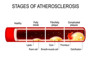 medical illustration showing the stages of atherosclerosis