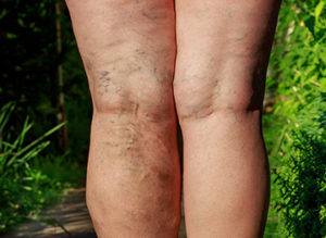photo of the disease varicose veins on a legs