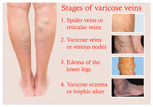 diagram showing the stages of varicose veins | Amish Tilara, M.D.