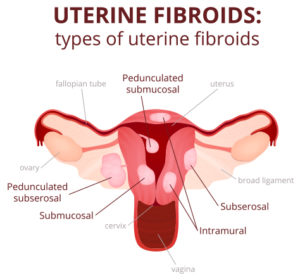 medical diagram showing Uterine Fibroids