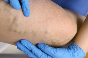 photo of veins in a leg being examined