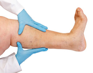 photo of lower limb vascular examination because suspect of venous insufficiency