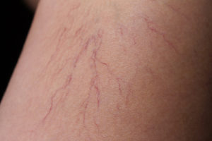 up close photo of spider veins | Atlanta Vascular & Vein Center