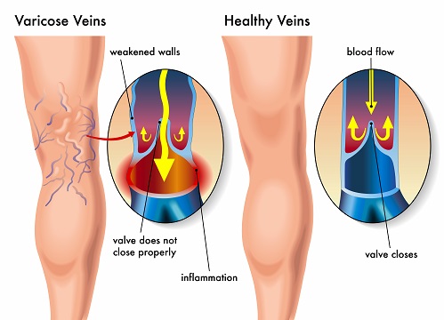 Varicose & Spider Veins - Atlanta Vascular & Vein Center